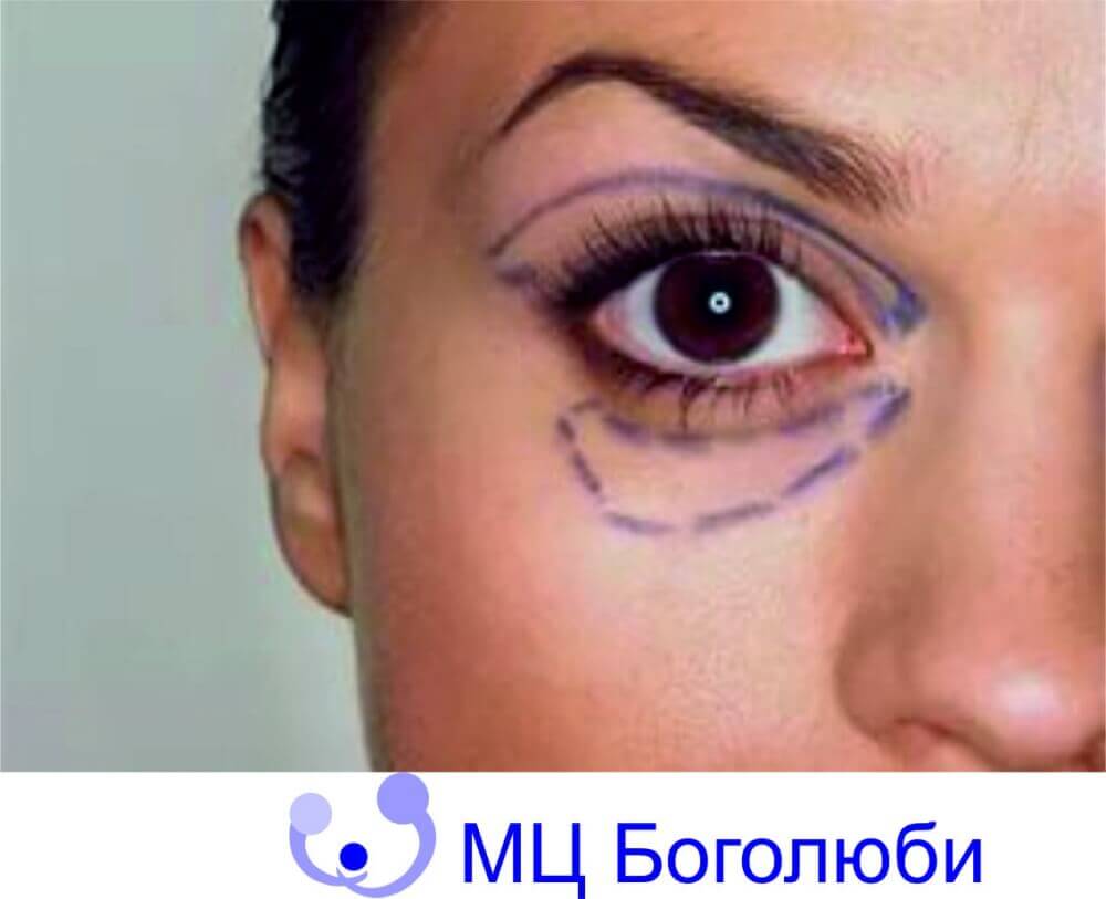 Blefaroplasty, фото