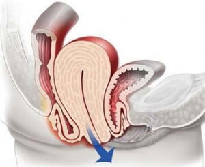 Выпадение матки, фото