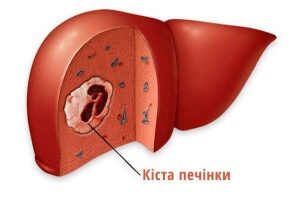 Hepatic cyst, фото