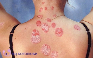 Psoriasis, фото